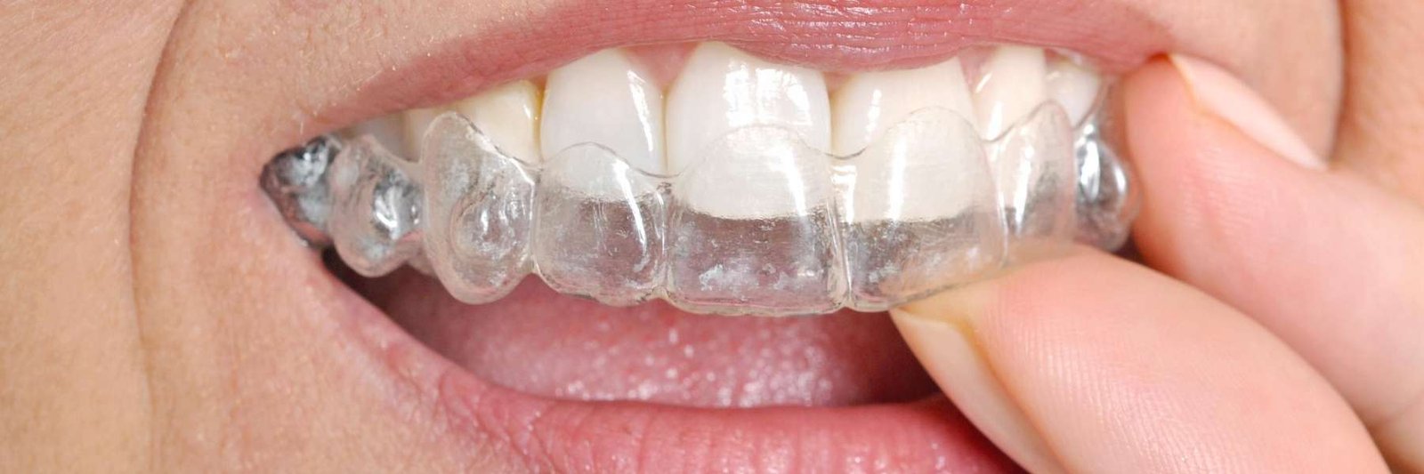 Invisalign Dedham | patient putting in top aligner