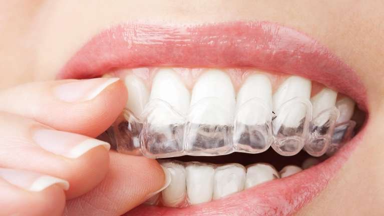 Invisalign dedham | woman putting in clear aligners