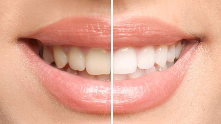 teeth whitening dedham | before and after whitening