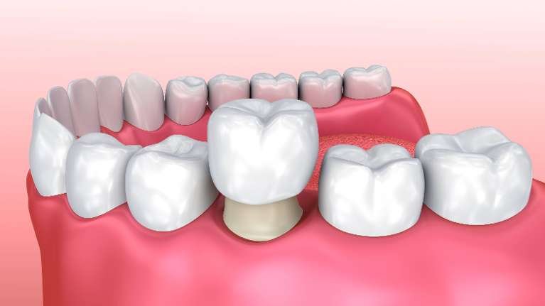 Diagram of a dental crown in Dedham MA