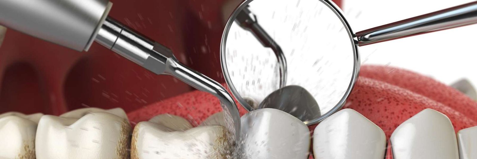 teeth cleaning dedham | preventive dentistry