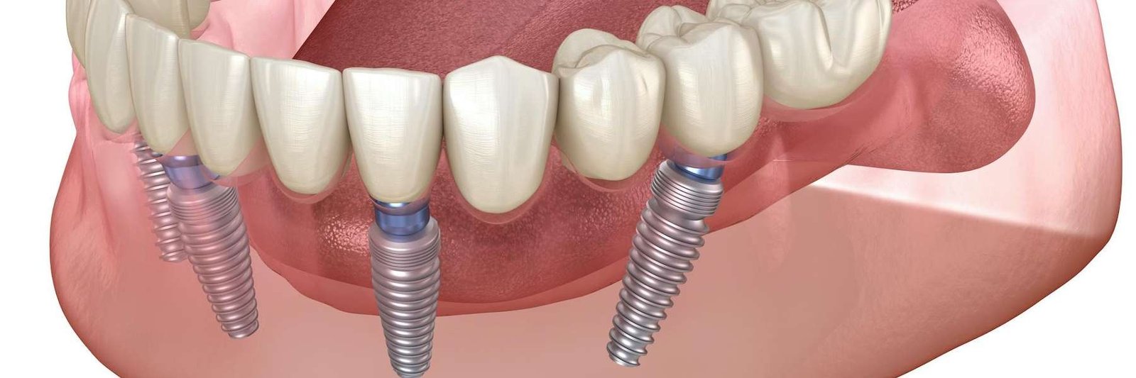 tooth extractions dedham | image of dental implants