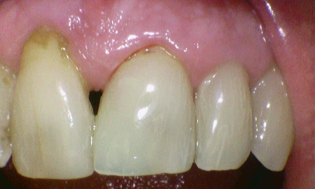 Chipped tooth after photo | emergency dentist hyde park