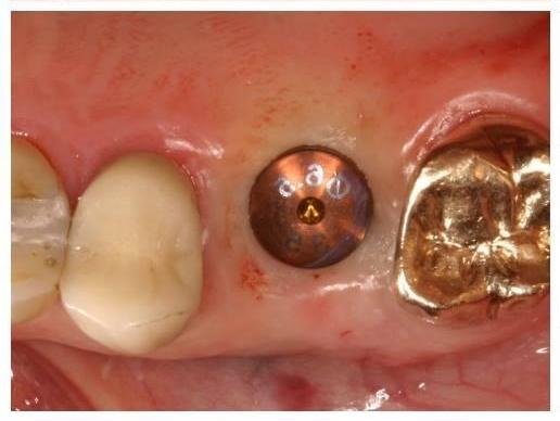 after photo dental implant dedham ma