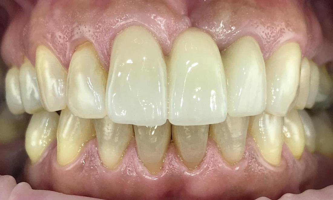 after photo missing tooth | tooth replacement dedham