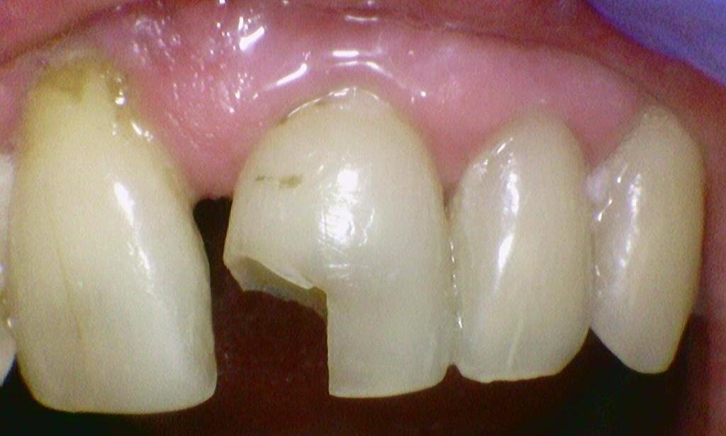 Chipped tooth before photo | emergency dentist hyde park