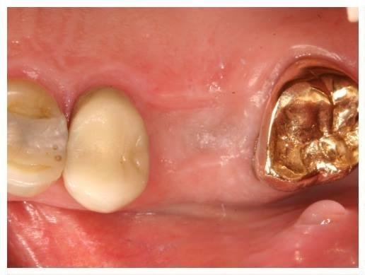 Missing tooth before dental implant dedham