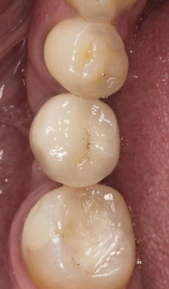 Dental-Implants-Can-Be-Simple-After-Image