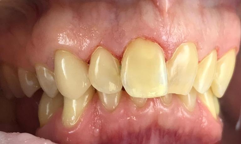 I-Have-So-Many-Cavities-After-Image