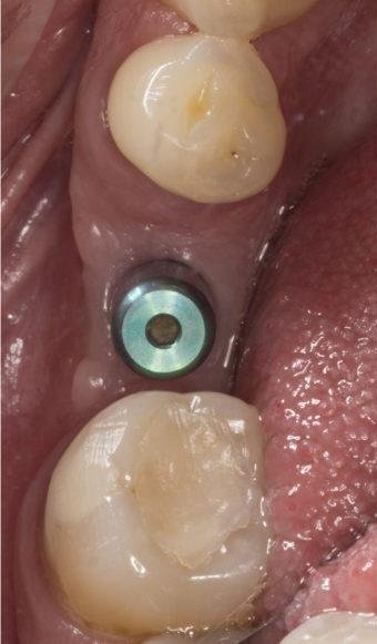 Dental-Implants-Can-Be-Simple-Before-Image