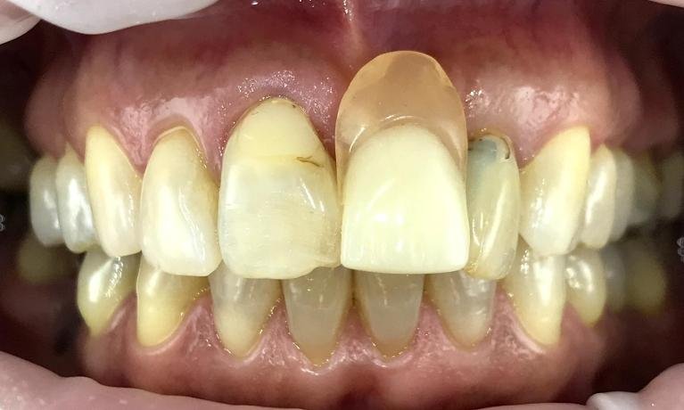 I-Can-Smile-Again-Before-Image