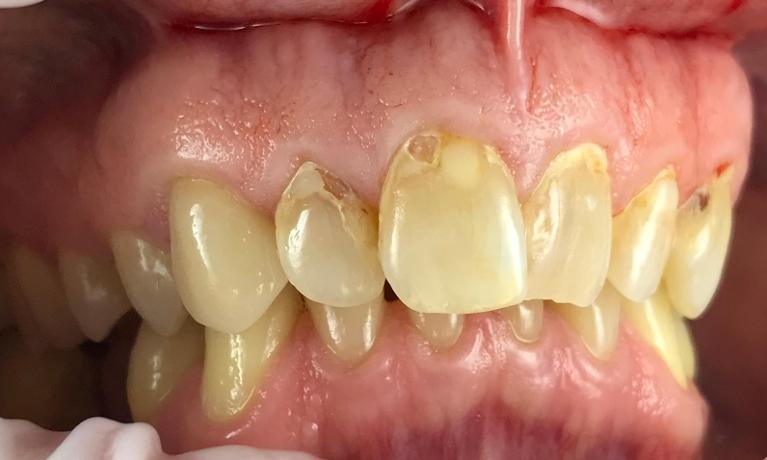 I-Have-So-Many-Cavities-Before-Image