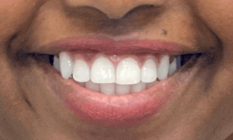 Invisalign-Before-and-After-6-Months-After-Image