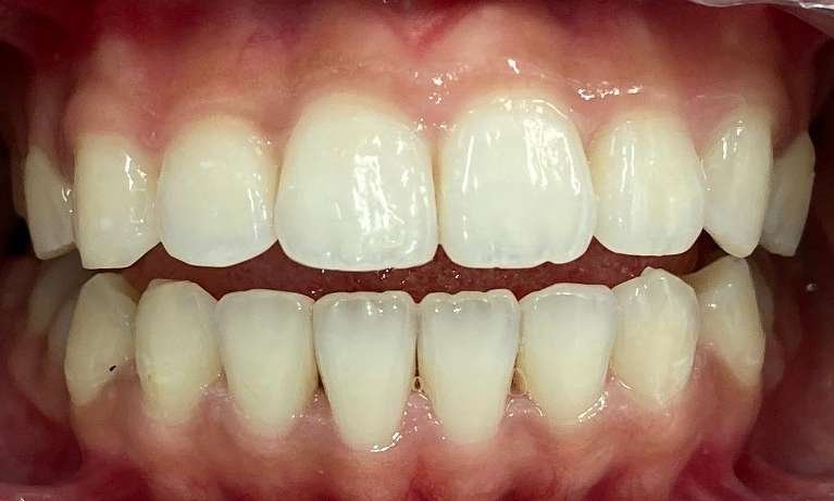 Invisalign-for-the-Smile-Win-After-Image