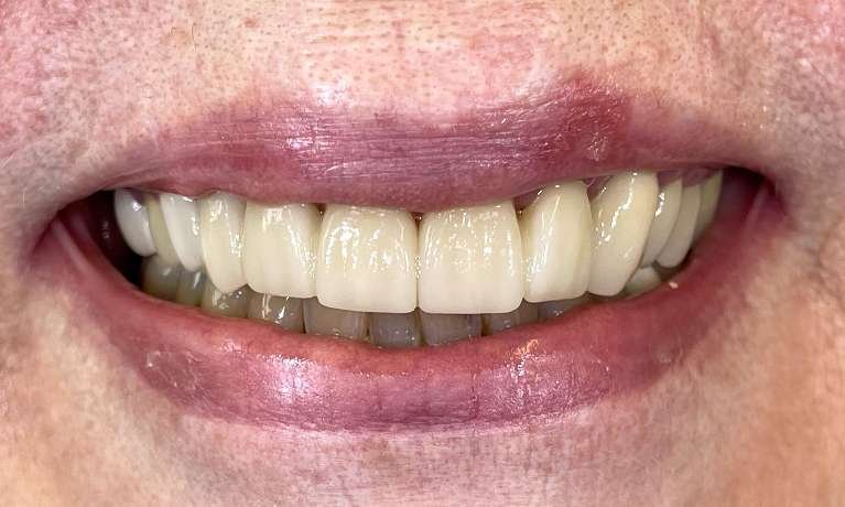 Full-Smile-Reconstruction-After-Image