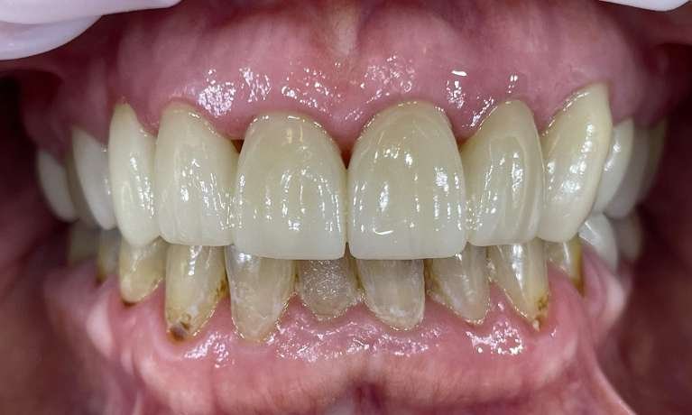 after photo cosmetic dentist in dedham ma