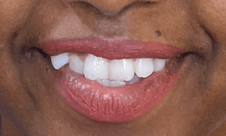 Invisalign-Before-and-After-6-Months-Before-Image