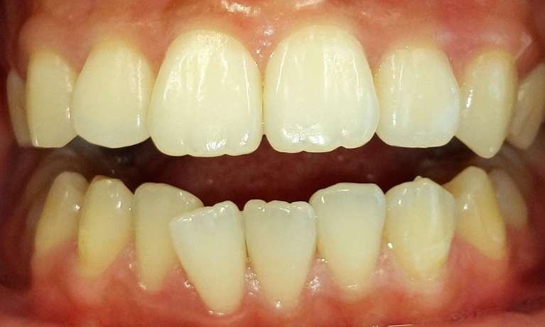 Invisalign-for-the-Smile-Win-Before-Image