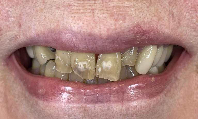 Full-Smile-Reconstruction-Before-Image