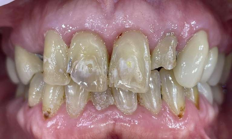 before photo cosmetic dentistry dedham ma